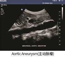 Aortic Aneurysm(대동맥류)