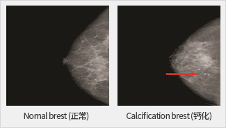 Normal brest(정상)과 Calcification brest(석회화) 촬영사진