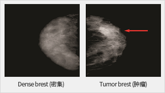 Dense brest(치밀)과 Tumor brest(종양) 촬영사진